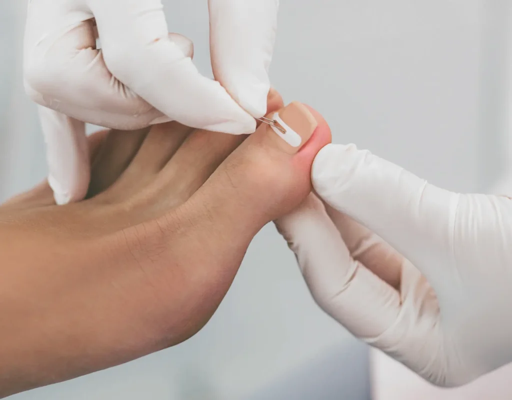 Nail Issues 1 doctor podiatry treats ingrown nail onychocryptos 2025 06 05 19 31 36 utc