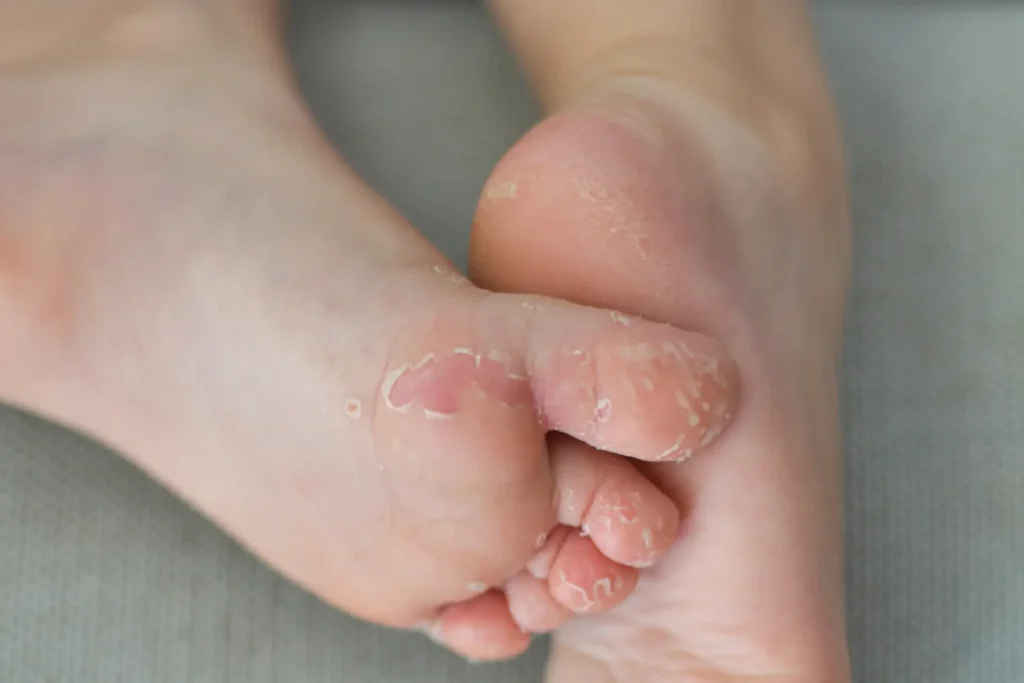 Calluses 1 enterovirus foot hand mouth skin peeled off on the 2024 11 26 18 59 07 utc 1