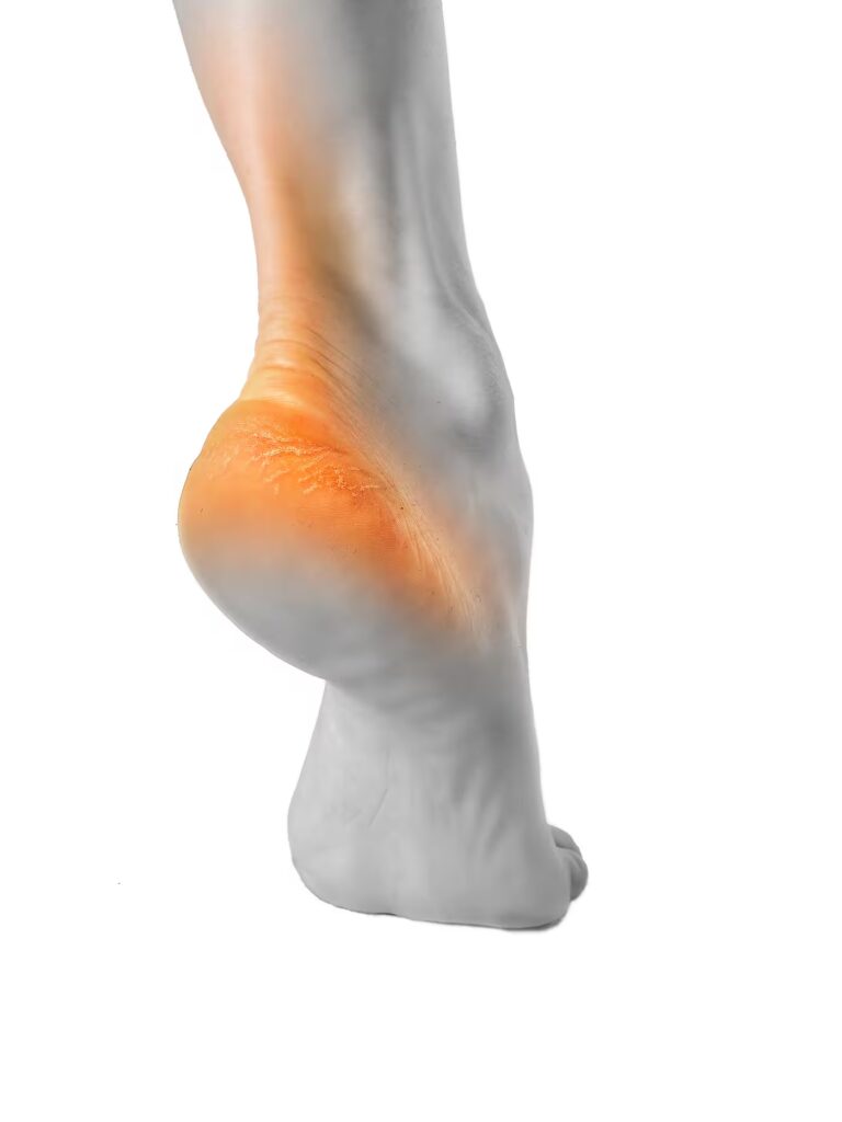 the heel of the foot with bad skin is covered with 2025 10 13 15 03 23 utc converted