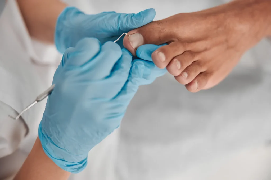 Ingrown Toenails 1 podiatrist in blue gloves cleans toenail of man us 2025 03 27 02 00 24 utc